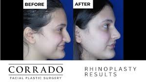 Before and After Pictures: Rhinoplasty Surgery