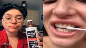 A Teeth Whitening Trend Went Viral On Tiktok But Is It Really Safe