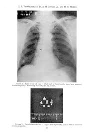 Image result for Broncholithiasis