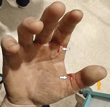 Image result for Hand Injury