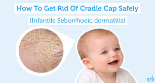 Image result for Cradle Cap