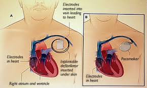 Your pacemaker or icd is a potentially lifesaving tool. Healthy Viewpoints Pacemaker Defibrillator And Your Non Cardiac Surgery