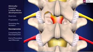 Hernia de disc poate apare in orice parte a coloanei vertebrale, de cele mai multe ori la nivelul inferior al coloanei (zona lombara). Hernia De Disc Lombara Simptome Cauze Diagnostic Si Tratament