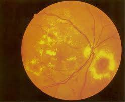 A group of metabolic diseases characterized by persistently elevated blood glucose levels and associated abnormalities in lipid and protein. Diabetes Mellitus Amboss
