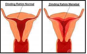 We did not find results for: Penebalan Dinding Rahim Penebalan Promil Bidan Via Facebook