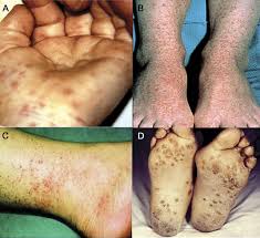 And body aches, occasionally with a skin rash and swollen lymph glands. Skin Rash In Meningitis And Meningoencephalitis Neurology