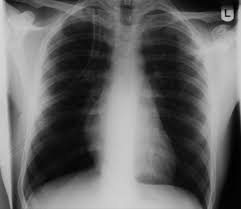A pneumothorax occurs when air leaks into the space between your lung and chest wall. Pneumothorax Fachkliniken Fur Geriatrie Radeburg Gmbh