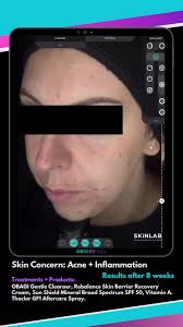 Acne + Inflammation can be so frustrating to deal with! But luckily it CAN  be treated! Just remember that we need to strip things back and take the  steps low and slow! ✨😍Amazing results again in just ...