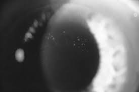 Psuedostratified epithelial tissue is epithelial tissue that looks as though it is multiple layers, i.e. Corneal Valance A Useful Sign In Epithelial Basement Membrane Dystrophy Eye