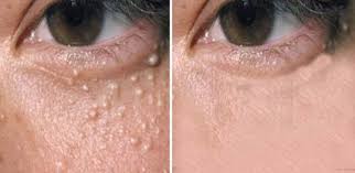 Acestea pot indica o încălcare a muncii unor organe interne. Ai Aceste Puncte De GrÄƒsime Pe FaÈ›Äƒ IatÄƒ De La Ce Apar Singura SoluÈ›ie Care Te ScapÄƒ De Ele