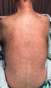 Image result for Neurosyphilis