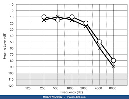 Tinnitus is commonly described as a ringing in the ears. Subjective Tinnitus Medlink Neurology
