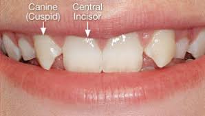 Image result for Central Incisors