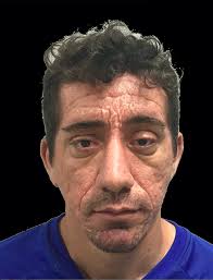 Postoperative result 1 y after the frontal lift