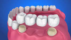 Gigi molar/geraham ini berguna untuk melumat makanan sebelum ditelan. Dental Bridge Gigi Palsu Permanen Yang Aman Digunakan
