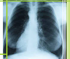 Wenn die luft an einem anderen ort als der brusthöhle austritt, hat das luftleck einen anderen namen. Pneumothorax Krankheitslexikon Gesund Co At