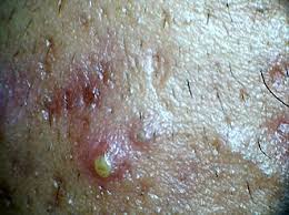 Image result for Pustule