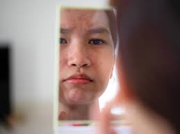 Aloe Vera For Skin Redness: Does it Help or Worsen Symptoms?