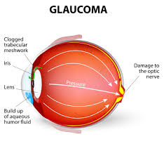 Glaucoma is a progressive vision condition that can lead to permanent blindness. Glaucoma The Signs Symptoms And Solutions Ocular Prosthetics Inc