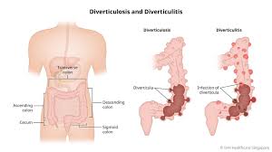Image result for Diverticulitis