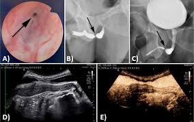 Image result for Retrograde Urethrogram