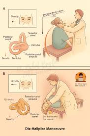 Image result for Canalith Repositioning Procedure