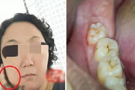 Sebelumnya saya juga pernah melakukan operasi geraham bungsu waktu masih muda dulu (cailah masi mudaaa~). Wanita Meninggal 5 Hari Usai Cabut Gigi Bungsu Keluarganya Tak Terima Dokter Sebut Penyebab Kematiannya Karena Tumor Semua Halaman Intisari