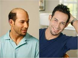 Wigs, weaves and hair extensions are similar, but they serve different purposes. Men Hair Weaving And Bonding Service For Parlour Personal Id 6623549448