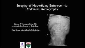 Image result for Necrotizing Enterocolitis