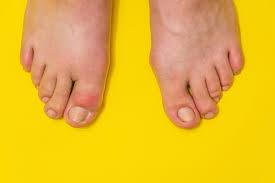 Image result for gout