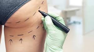 Frequently asked questions about bbl. Brazilian Butt Lift Das Gefahrliche Geschaft Mit Dem Hintern