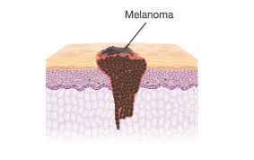 Basal cell carcinomas and squamous cell carcinomas are more common in older people. Types Of Skin Cancer Oncobeta