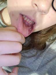 Bruising After Lip Peircing I Know It S Not The Best Picture But Is It Normal It Bled When I First Got It Done But Stopped After 5 Minutes Blood Vessel Popped Maybe