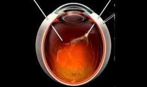 Dezlipirea de retină (ruptura de retină) apare atunci când membrana subțire din spatele ochiului numită retină se desprinde de vasele de sânge care întrebări frecvente despre dezlipirea de retină. Dezlipirea De RetinÄ Q Vision