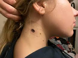 Is mole removal healing normal?