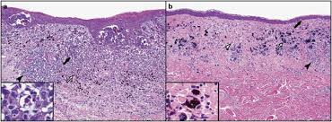 Melanin is the pigment that gives. Regression In Primary Cutaneous Melanoma Etiopathogenesis And Clinical Significance Laboratory Investigation