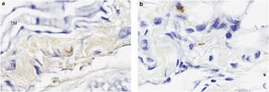 This disease is the most common vector borne disease in the united states, affecting far more individuals than west nile virus. Dynamics Of Connective Tissue Localization During Chronic Borrelia Burgdorferi Infection Laboratory Investigation