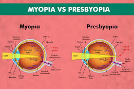 Image result for Presbyopia
