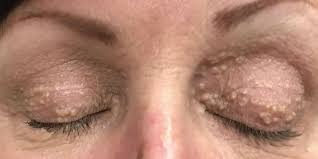 This is an old chain but i went to the dermatologist for this same issue today thinking these were milia under my eyes. Watch Dr Pimple Popper Remove So Many Milia From This Patient S Eyelids Dr Pimple Popper