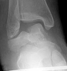 Image result for Talus Fracture