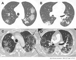 It was first identified in december 2019 in wuhan,. The Reversed Halo Sign And Covid 19 Possible Histopathological Mechanisms Related To The Appearance Of This Imaging Finding Archivos De Bronconeumologia