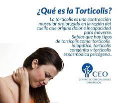 Check spelling or type a new query. Dr Fidel Cayon Sabias Que La Torticolis Es Una Facebook