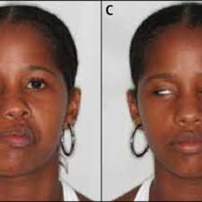 Reports released from pfizer and moderna show that seven. Clinical Appearance Of Bell S Palsy On The Right Side During The First Download Scientific Diagram