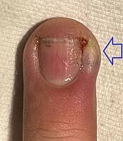 Image result for paronychium