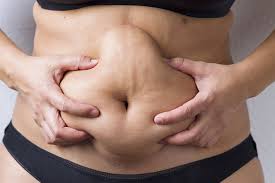 Skin Tightening After Weight Loss Or Pregnancy Plastic Surgeon In Winnipeg Mb Dr Avi Islur