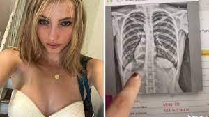 X-ray reveals woman's heart is on the wrong side | news.com.au —  Australia's leading news site