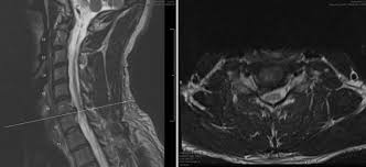 Spondylosis is a natural aging process of the spine. Cervical Radiculopathy Spine Orthobullets