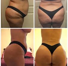 The atlanta clinic will have you feeling that hollywood lifestyle without paying the hollywood price. Mia Aesthetics On Twitter From Saggy To Sassy Check Out This Miababe Just 6 Weeks After Surgery This Could Be You But You Playing Miaaesthetics Miami Bbl Comeonin Https T Co Fpdb4mxxvp Twitter