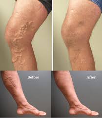 Pin On Varicose Veins