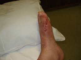 A person may require a surgical boot after bunion removal surgery. Bunion Surgery The Best Keeping You In Stitches